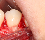 External cervical resorption - Post-op case 1